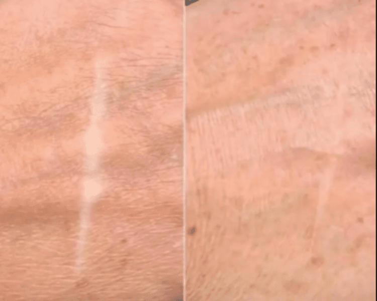 Camuflaje Cicatrices / Vitiligo / Estrías (Tamaño S)