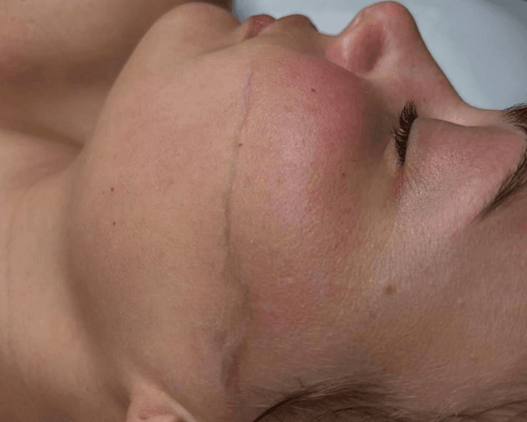 Dermaplaning (incluye limpieza facial profunda)