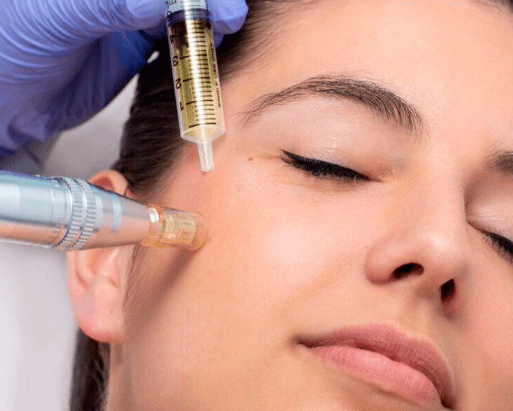 Microneedling Facial
