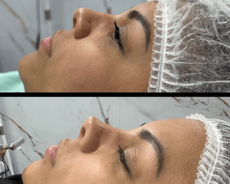 Rinomodelación (12 a 18 meses)