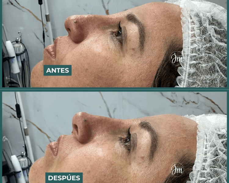 Rinomodelación (24 meses)