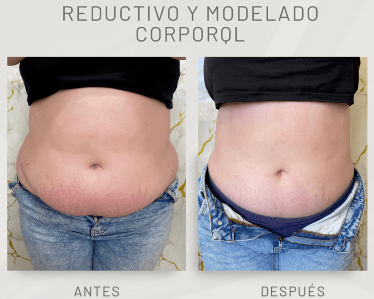 reductivo y modelado corporal ( abdomen , espalda o piernas )