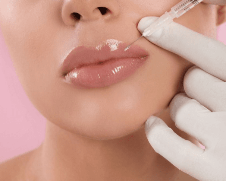 VOLUMEN DE LABIOS - ácido hialurónico