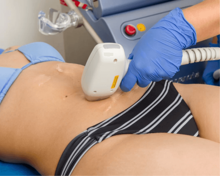 LÁSER CUERPO COMPLETO · MUJER (1 SESIÓN)