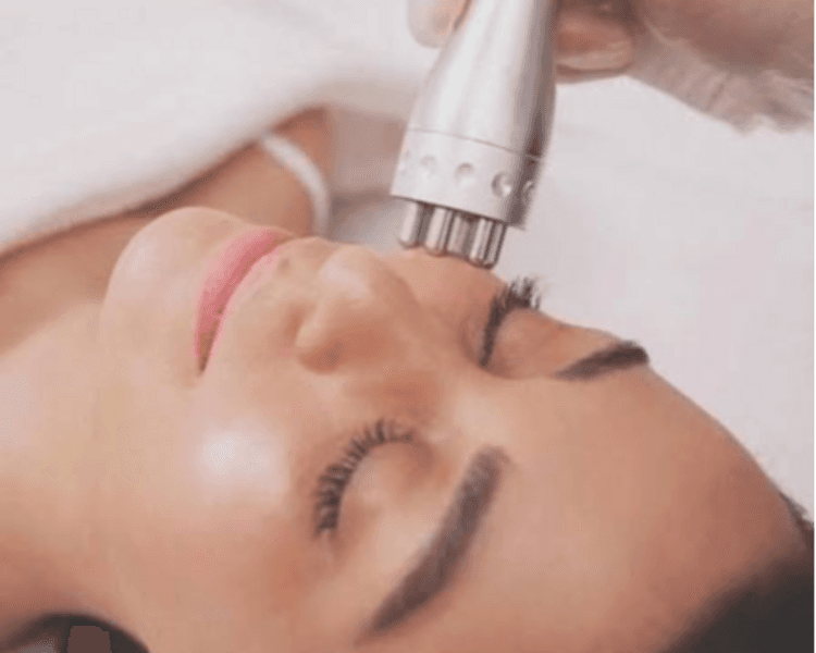 Radiofrecuencia facial