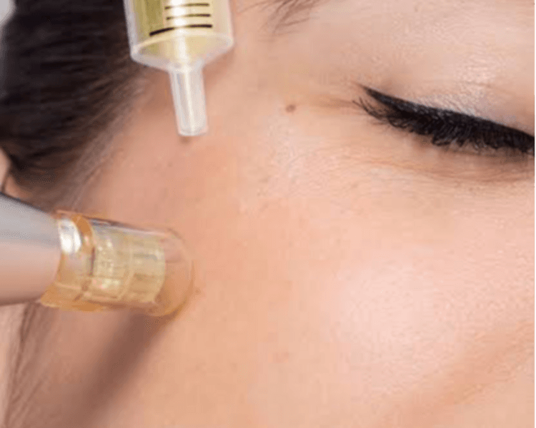 Combo mensual plasma facial