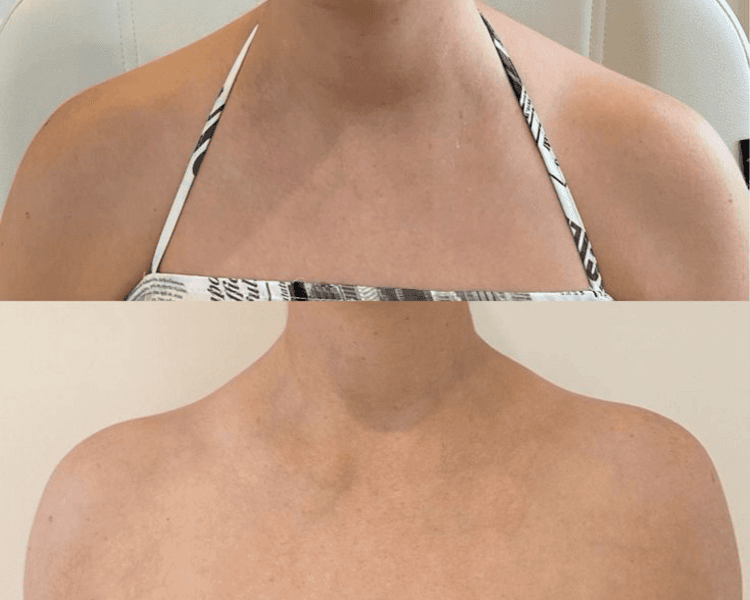 Trap Botox – Afinamiento cervical y estilización de hombros