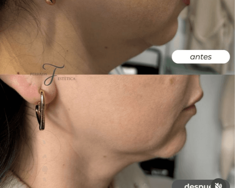 6 sesiones Lifting facial con Endymed Pro