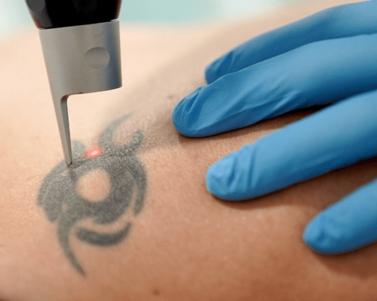 Retiro de Tatuajes Pico Segundos