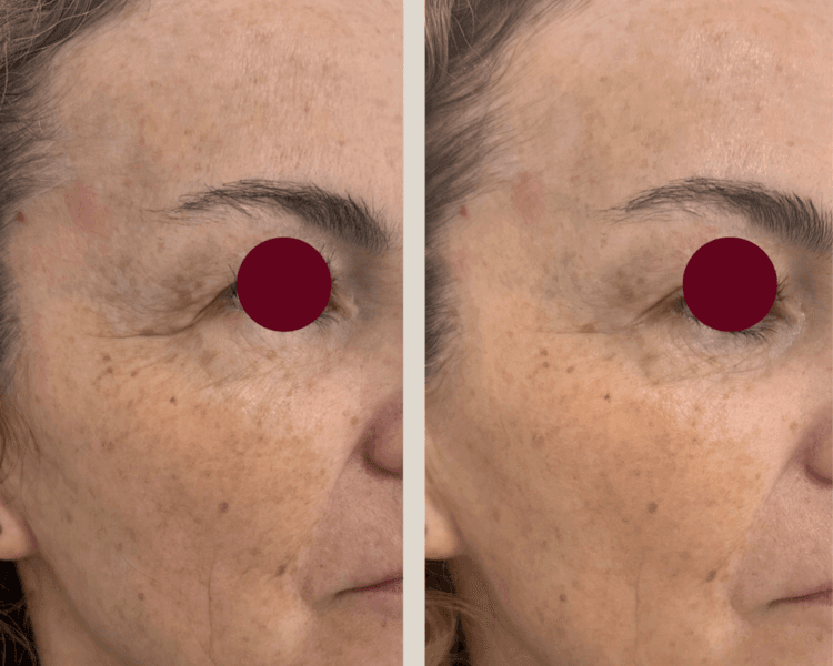 Lifting facial full face