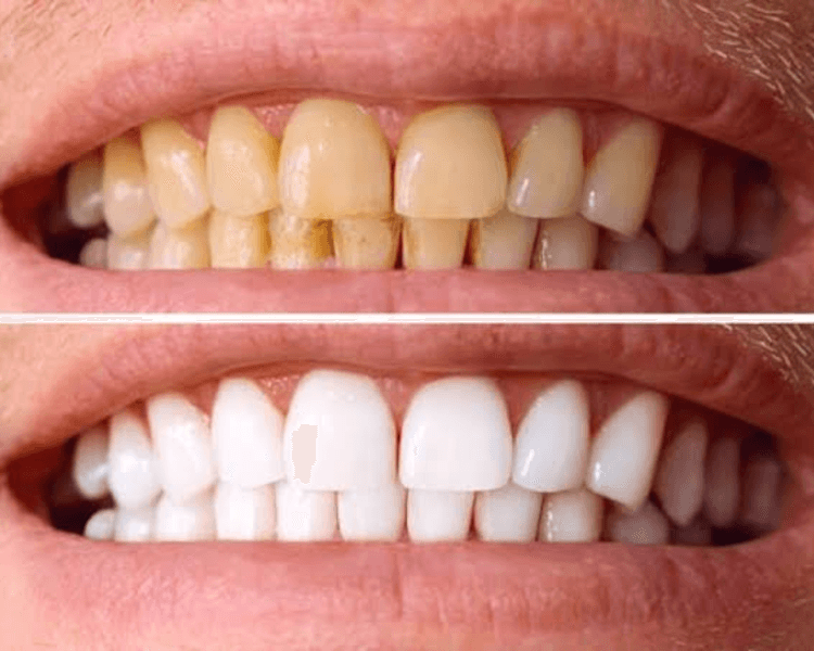 Blanqueamiento Dental