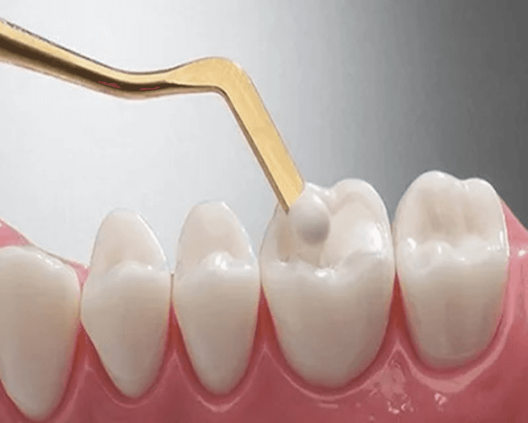 Restauración dental (tapaduras)