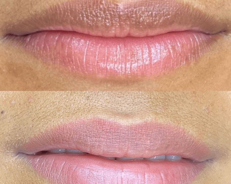 Neutralización de labios