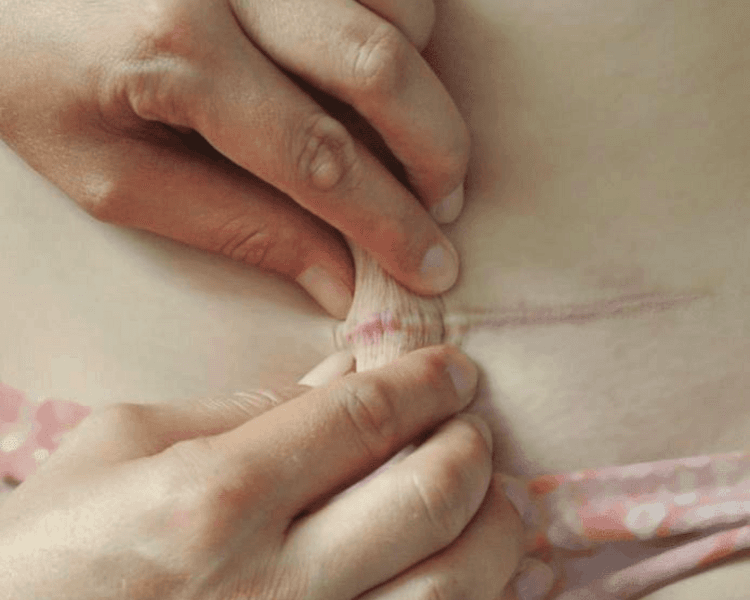 Post operatorio Cirugía Plástica Corporal