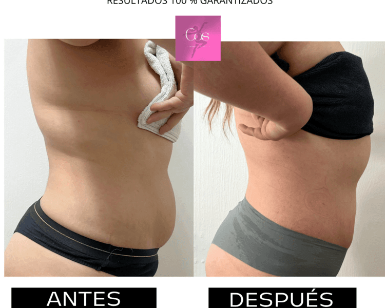 LIPOESCULTURA sin cirugía tripollar 4 sesiones