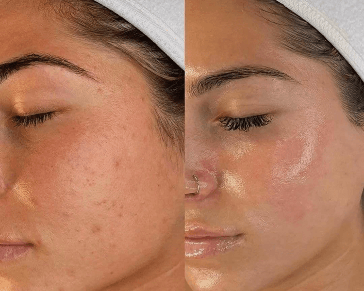 Limpieza + Dermaplaning