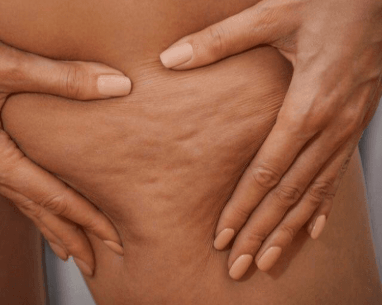 Masajes para celulitis, Masaje circulatorio + maderoterapia + drenaje linfatico manual