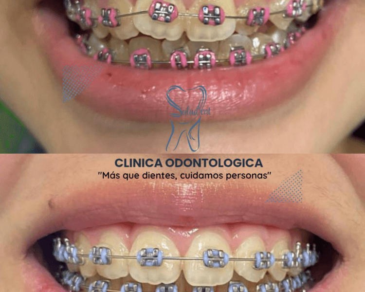 🦷 Ortodoncia para Niños y Adultos