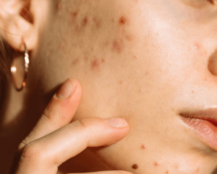 Tratamiento para acné