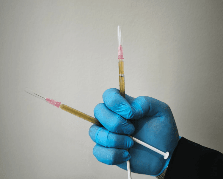 Tratamiento de plasma rico en plaquetas facial