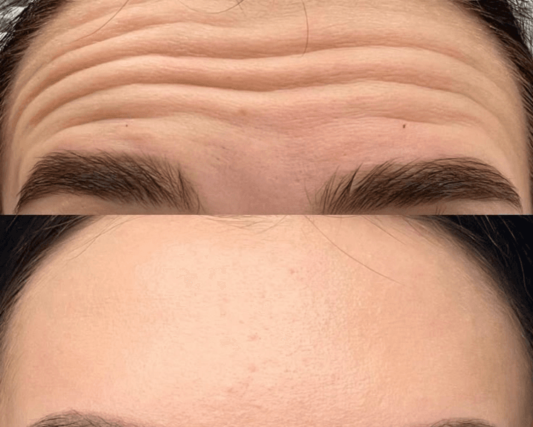 Toxina Botulinica 2 zonas