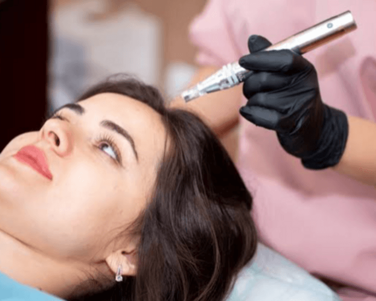 Microneedling facial y capilar