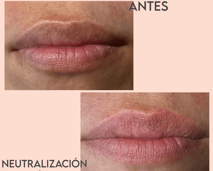 Neutralización de Labios Oscuros