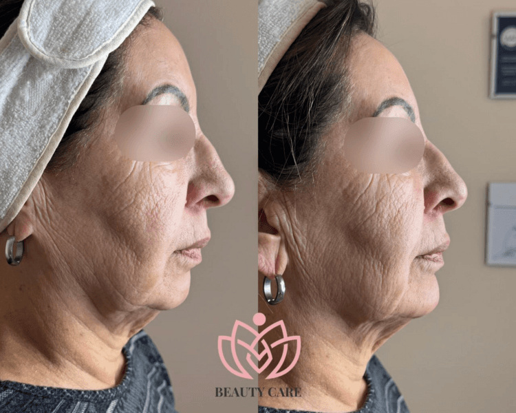 Relleno de Tercio Inferior - Reborde Mandibular (Hyalromax- Filltec)