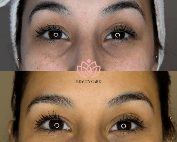 Relleno de Ojeras (Hyalromax- Filltec)