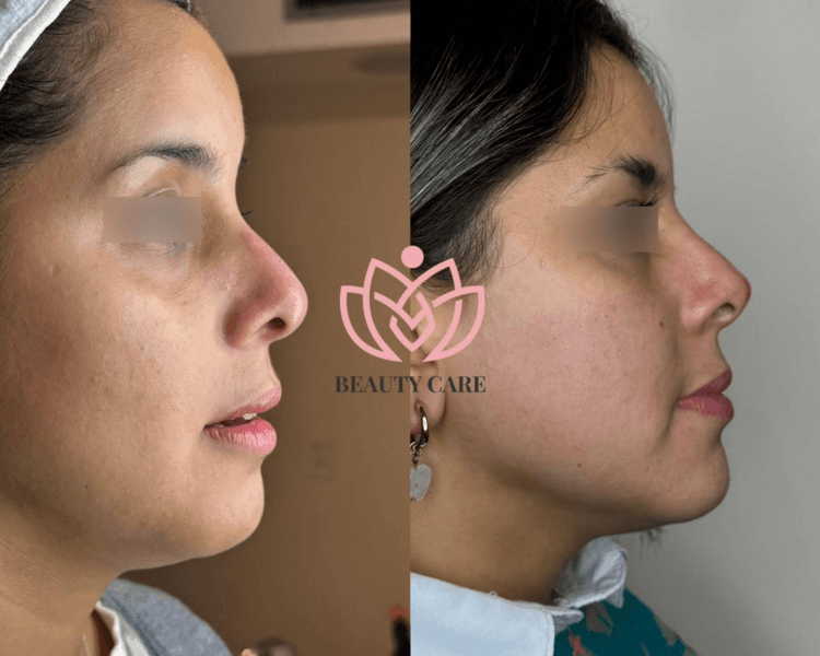 Rinomodelacion (Hyalromax- Filltec)