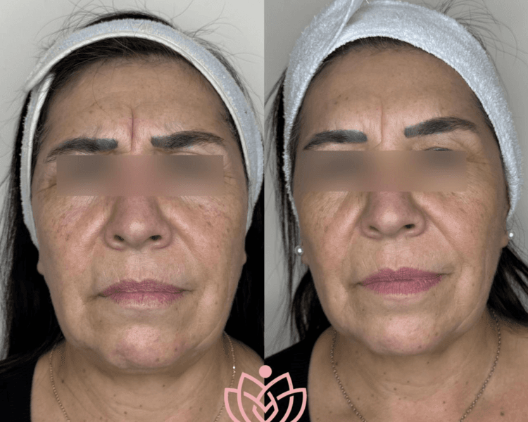 Nuit (Hidroxiapatita de Calcio)