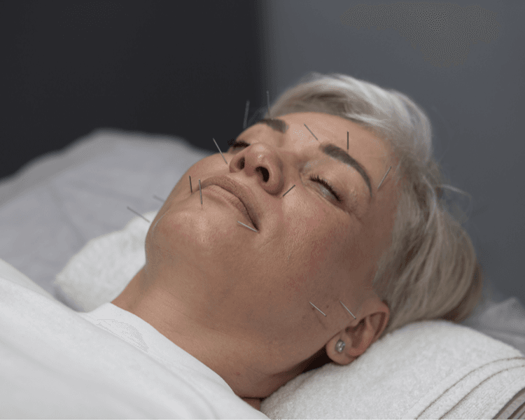 Acupuntura facial