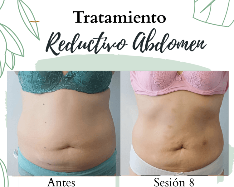 Tratamiento Reductivo Abdomen Desde $24.990