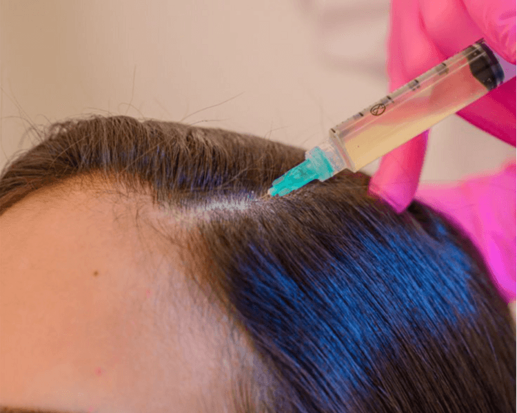 Mesoterapia de Activación Folicular Avanzada