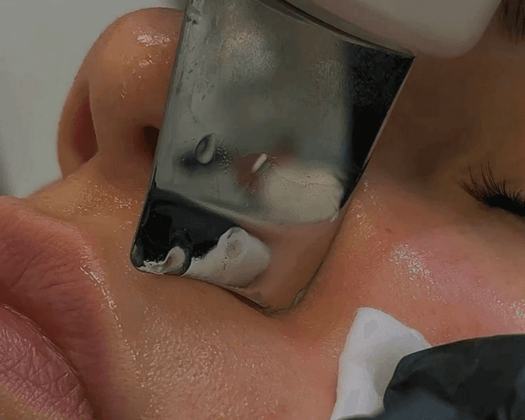 Limpieza Facial (PROFUNDA CON EXTRACCIONES)