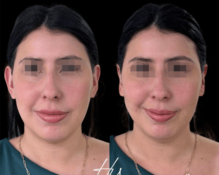 Otomodelación Definitiva 2 Orejas