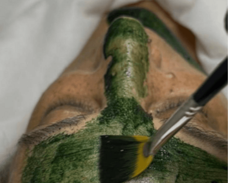 💎Peeling Médico Específico (para Acné / Manchas / Rosácea / Cicatrices / Hidratación)