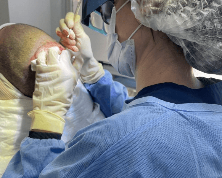 🧑🏻⚕️Implante Capilar – Técnica FUE 🧬