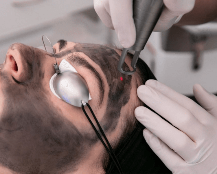 Hollywood Peel (3 sesiones)