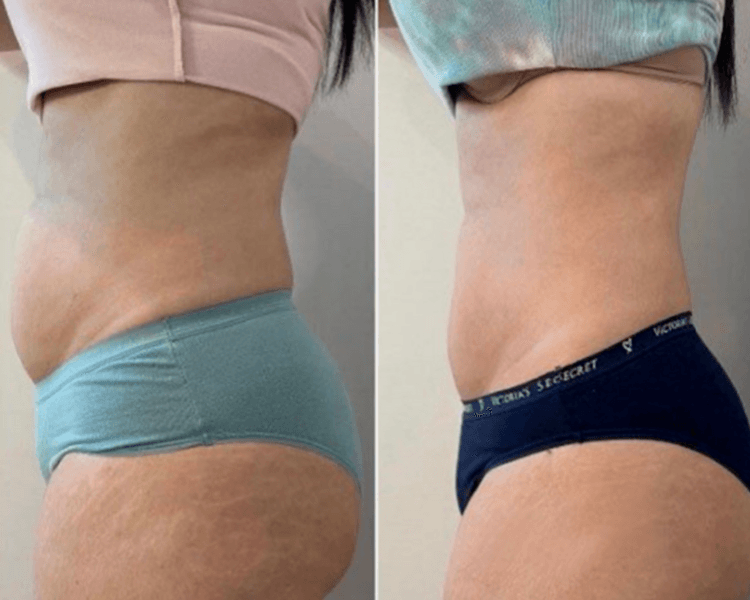 Masajes anticelulítico/modelador/maderoterapia/ bambuterapia