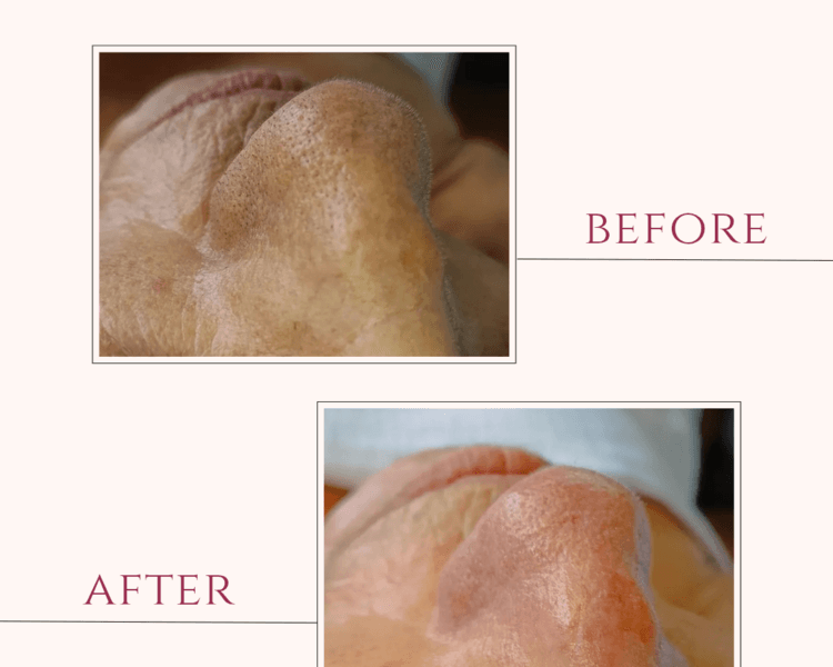 🌿 Limpieza Facial Profunda Personalizada