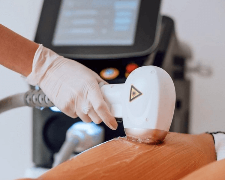 Depilacion definitiva