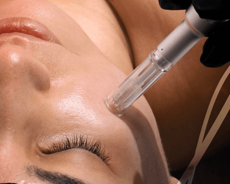 Microneedling - Dermapen
