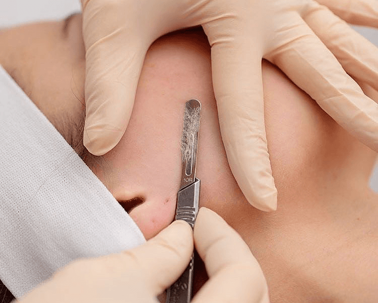 Glow Natural - Dermaplaning