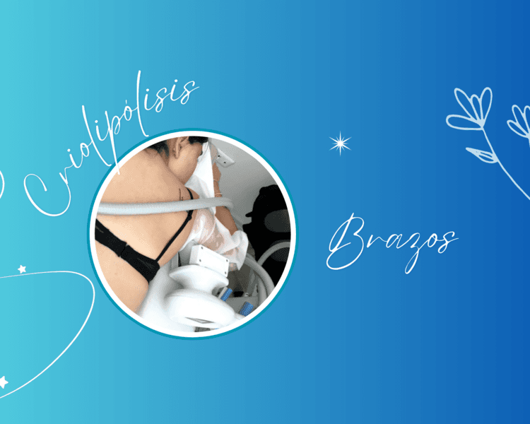 CRIOLIPÓLISIS BRAZOS 🧊