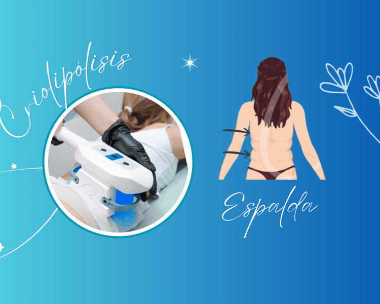 CRIOLIPÓLISIS ROLLITOS ESPALDA🧊