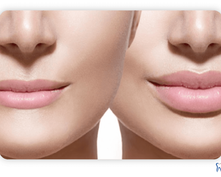 Perfilamiento No Reticulados