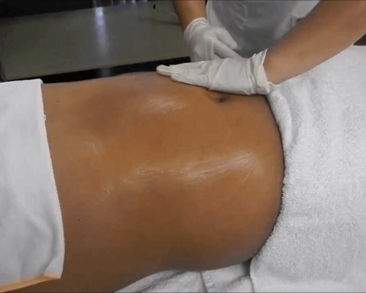 Drenaje Linfático Postoperatorio