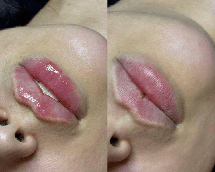 Aumento de labios