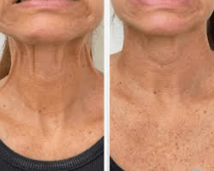 Botox cuello (Neck botox)